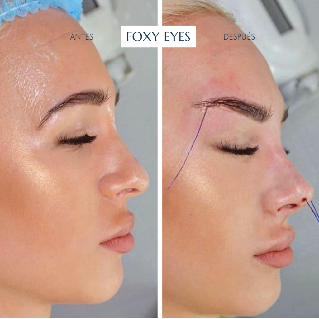 Cirugía de foxy eyes