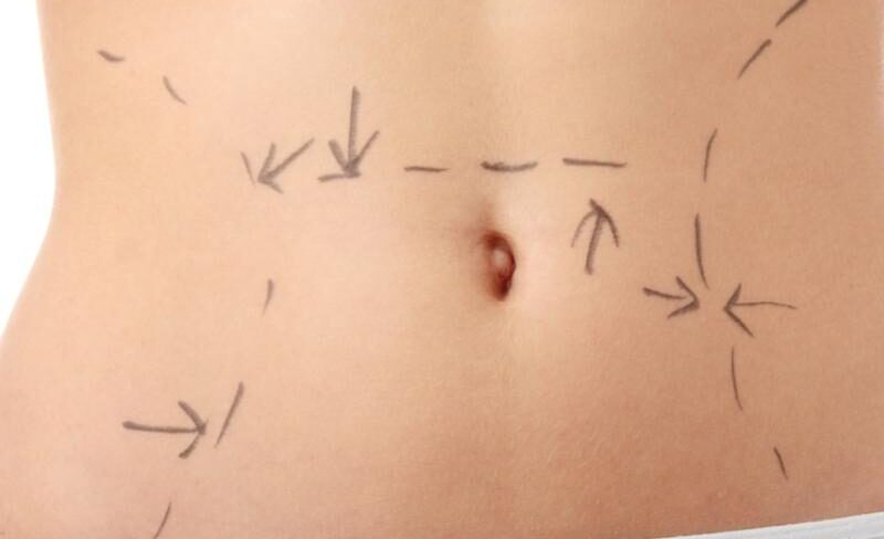 La abdominoplastía es un procedimiento que ayuda a mejorar la apariencia del abdomen